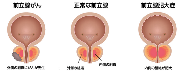 前立腺がんとハゲの関連性 強く関連しています 院長ブログ 五本木クリニック
