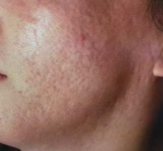 Japan Image 鼻 ニキビ跡 穴