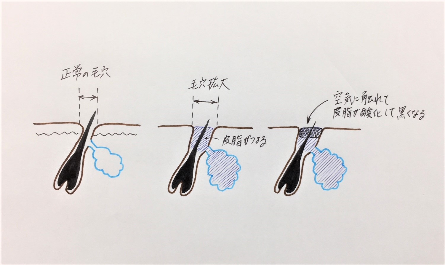 毛穴が目立つ7つの原因と対処法 Dr 松下ブログ 五本木クリニック