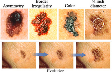 メラノーマ・悪性黒色腫の特徴