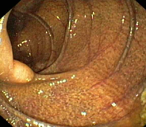 colon2