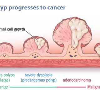 They_found_colon_polyps__Now_what__-_Harvard_Health