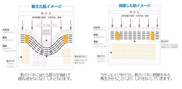 ラディエイジの治療効果