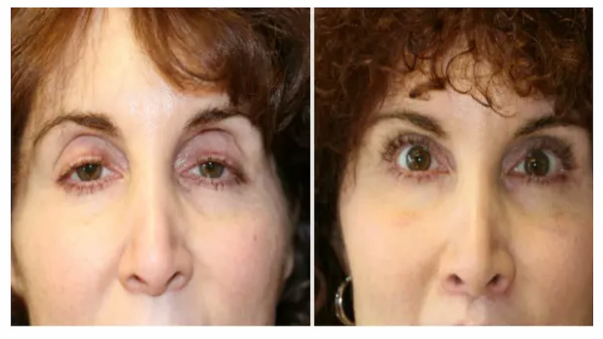 眼瞼下垂手術　眼科と美容外科の治療の違い
