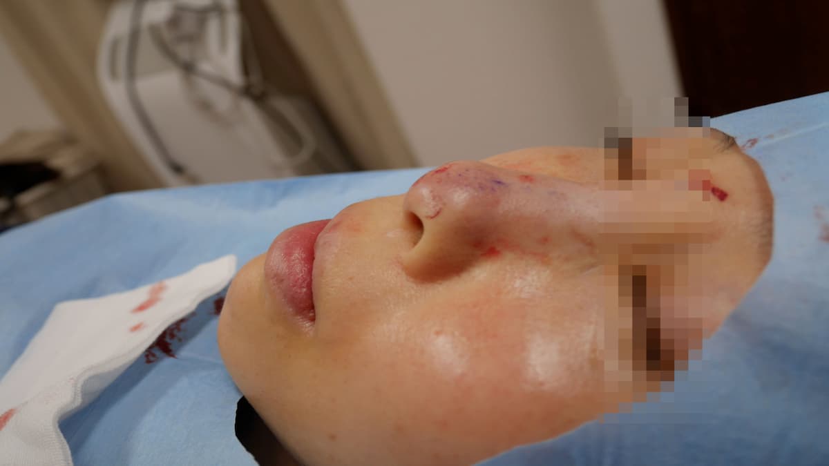 修正手術への取り組み、鼻プロテーゼの問題点とは？
