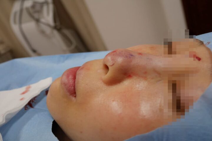 修正手術への取り組み、鼻プロテーゼの問題点とは？