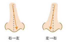 プロテーゼで左右に曲がった鼻