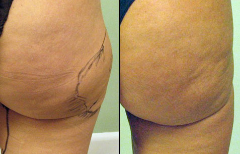 liposuction_3