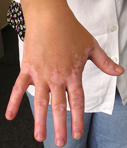 Vitiligo03