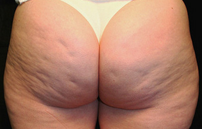 cellulite_1