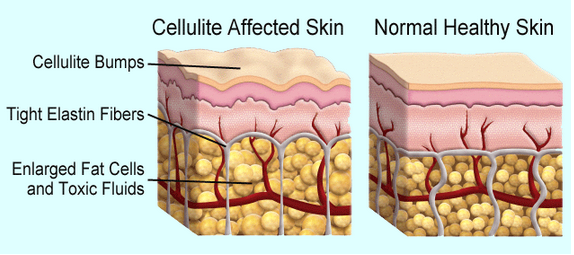 cellulite_4