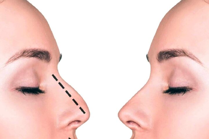 切らないで鼻の形を修正治療する方法〜特に「わし鼻」にボトックスが効果を発揮します