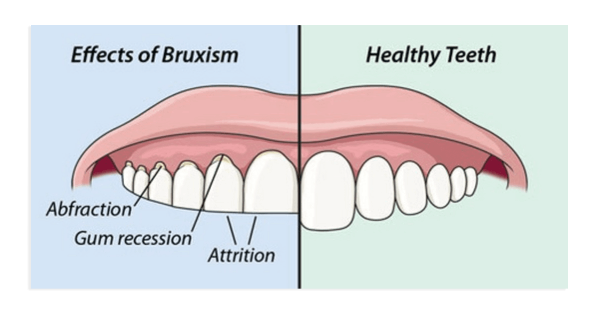 歯ぎしりとにストレスは本当に関係あるの？という素朴な疑問⋯原因と結果が逆じゃない？