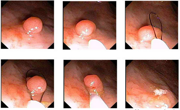 大腸ポリープ切除