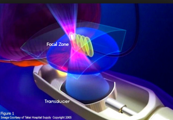 HIFU (高密度焦点式超音波治療法 High Intensity Focused Ultrasoundハイフ