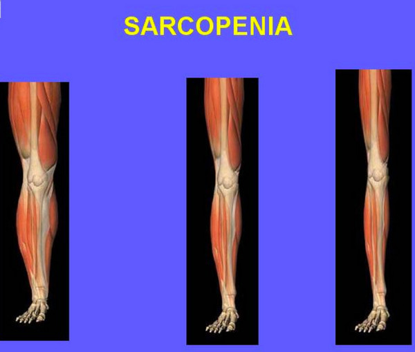 サルコペニアの筋肉の状態