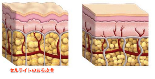 セルライトのイメージイラスト