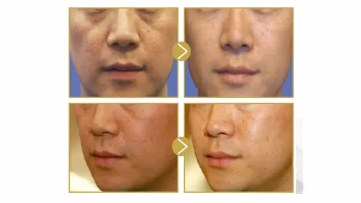 「ネオVリフト」という頬のたるみやほうれい線を解消する新しい治療法
