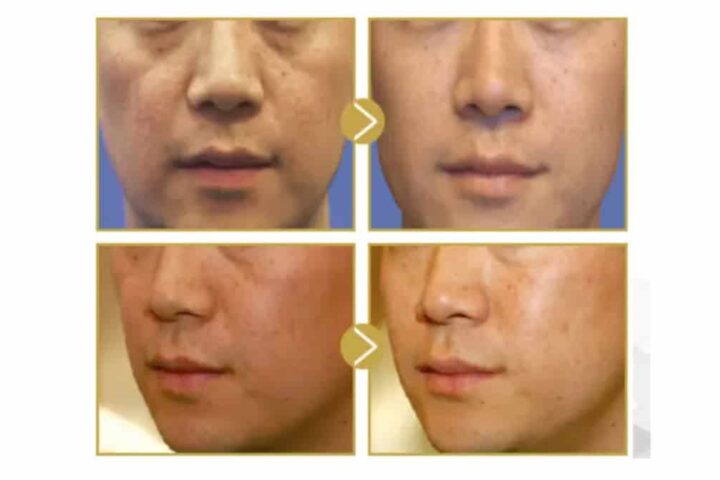 「ネオVリフト」という頬のたるみやほうれい線を解消する新しい治療法