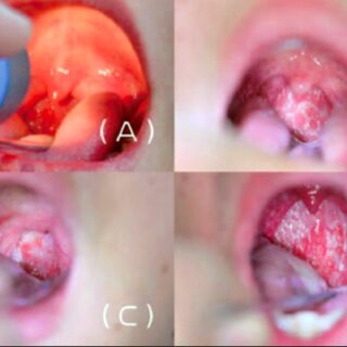 検査無しでインフルエンザかどうか見分ける方法