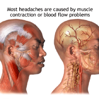 ほとんどの頭痛は筋肉が原因