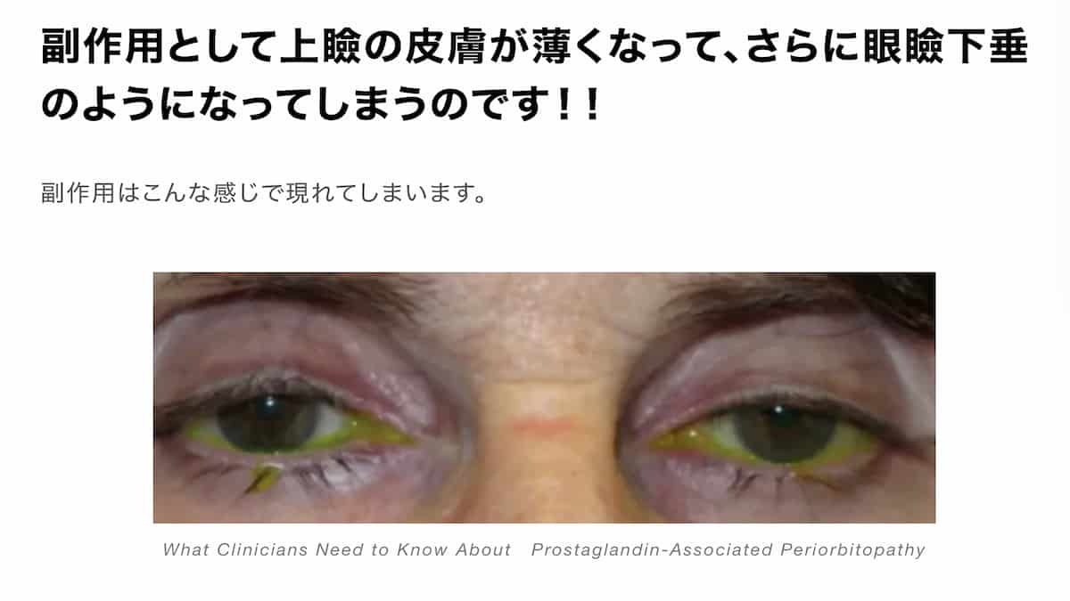 まつげ美容液 の思わぬ副作用 瞼が垂れ下がってしまう 重大な副作用の報告がありました 院長ブログ 五本木クリニック