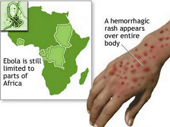 Ebola-Hemorrhagic-Fever-rash-on-hand_jpg__500×392_