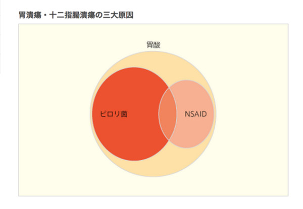 アステラス製薬–なるほど病気ガイド–胃潰瘍・十二指腸潰瘍_病気の基礎知識