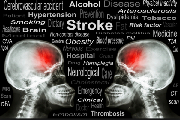 Chronic_Stress__Depressive_Symptoms__Anger__Hostility__and_Risk_of_Stroke_and_Transient_Ischemic_Attack_in_the_Multi-Ethnic_Study_of_Atherosclerosis_-_Google_検索