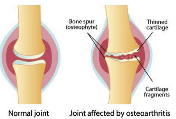 Glucosamine_Chondroitin_knee_pain_png__449×322_