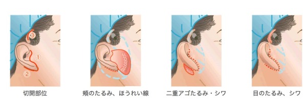 男性：顔・輪郭のたるみ___五本木クリニック