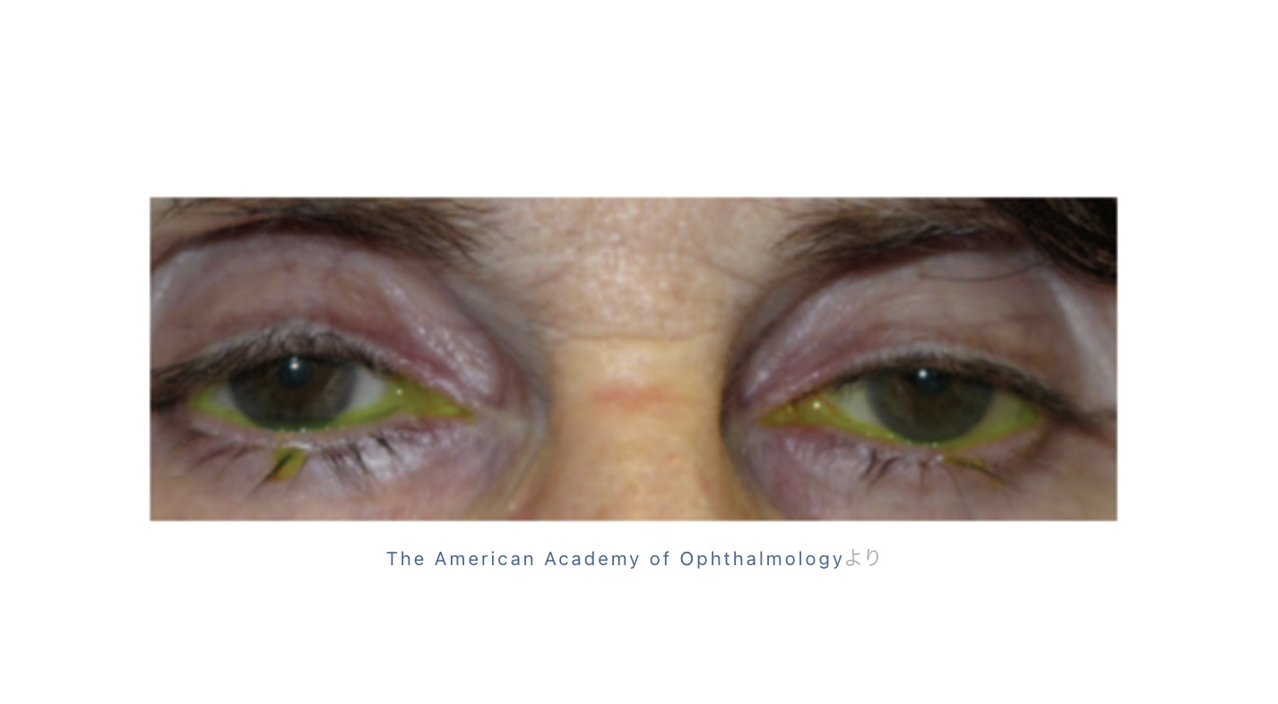 医師も認める睫毛美容液 グラッシュビスタ その副作用についても知っておきましょう 院長ブログ 五本木クリニック 医師も認める睫毛美容液 グラッシュビスタ その副作用についても知っておきましょう 院長ブログ 五本木クリニック