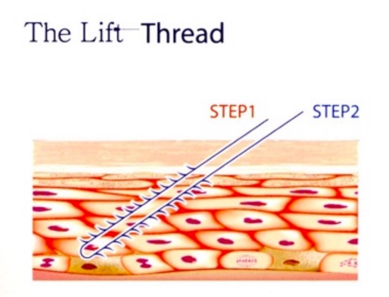糸を使ったフェイスリフトの原理