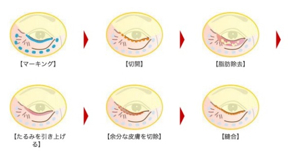 顔：目の下のたるみ___五本木クリニック
