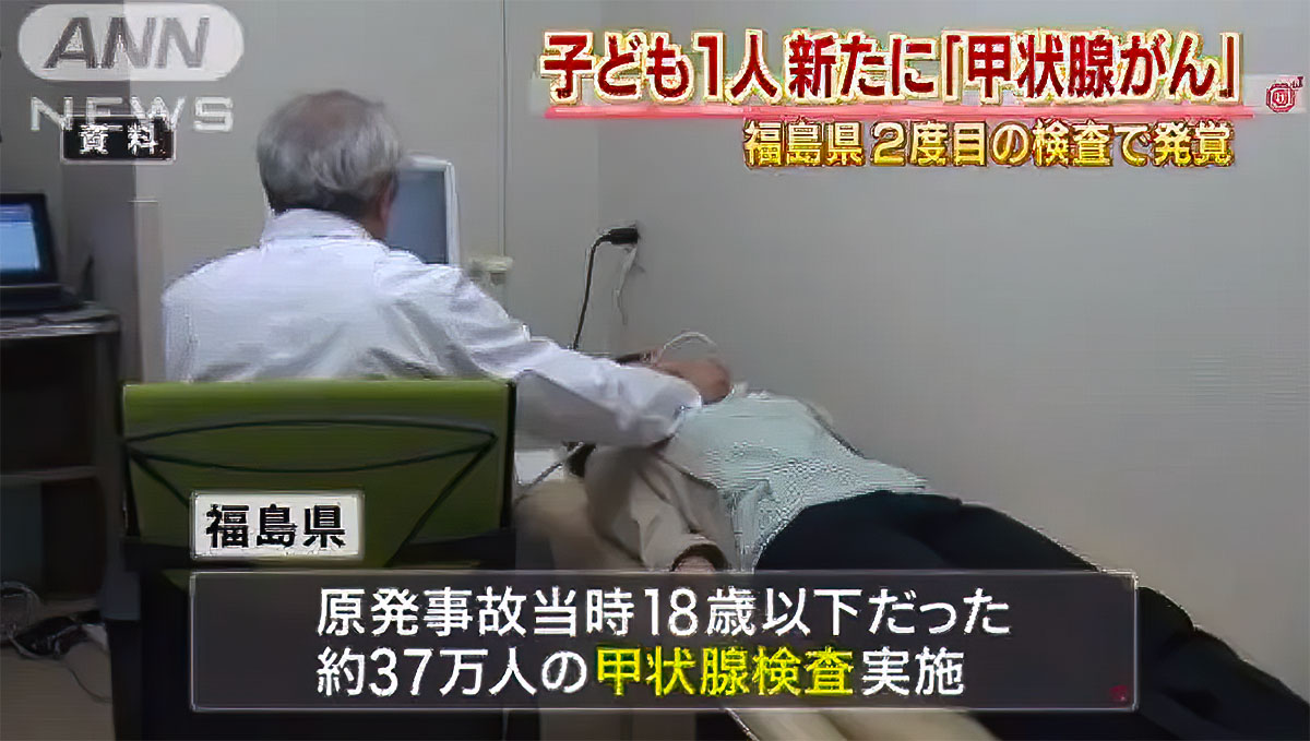 福島で子供に「甲状腺がん」が発見された、という記事は冷静に考える必要があります。