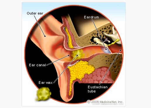 Ear_Wax__Click_for_Pictures_and_Home_Remedies