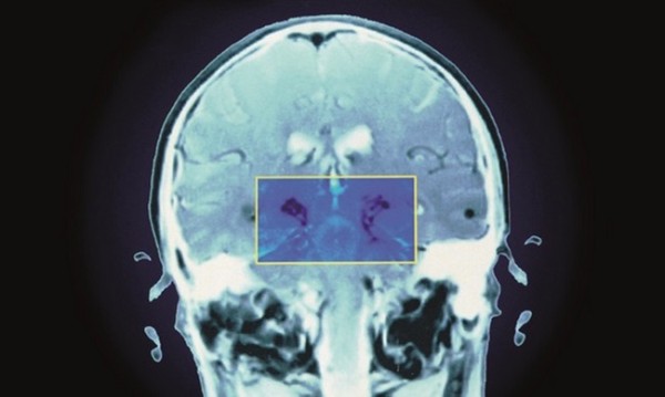 Perception_of_drug_cost_influences_placebo_response_in_Parkinson’s_disease___News___Pharmaceutical_Journal