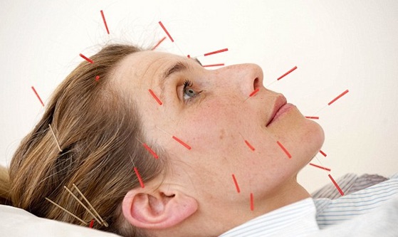 _Cosmetic__acupuncture_is_the_newest_weapon_in_the_anti-ageing_war__but_can_it_really_give_you_a_facelift__Or_does_it_just_leave_you_with_pins_and_needles____Daily_Mail_Online