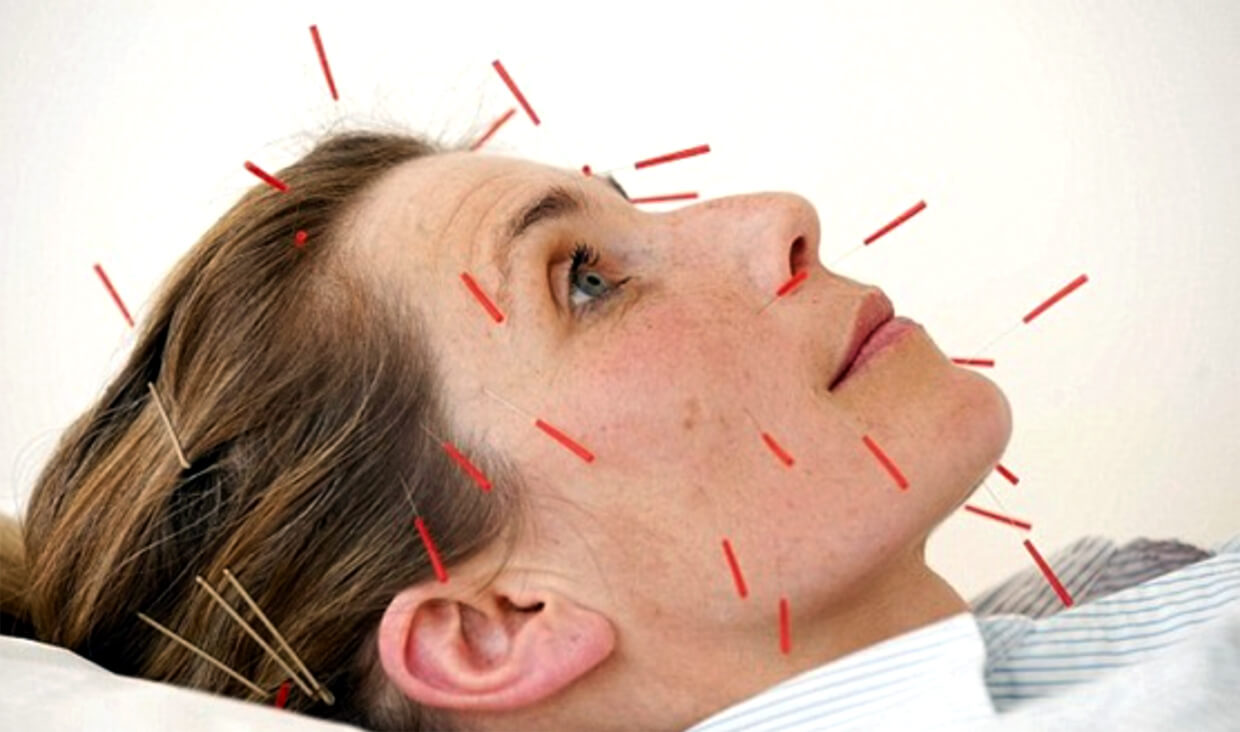 beauty-acupuncture