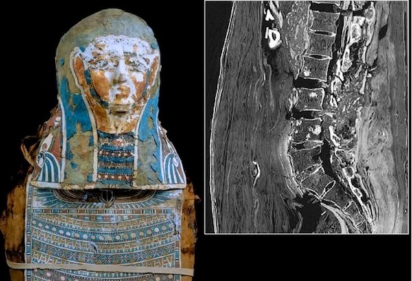 世界で2番目に古い「前立腺がん」が、古代エジプトのミイラから発見される_«_WIRED_jp