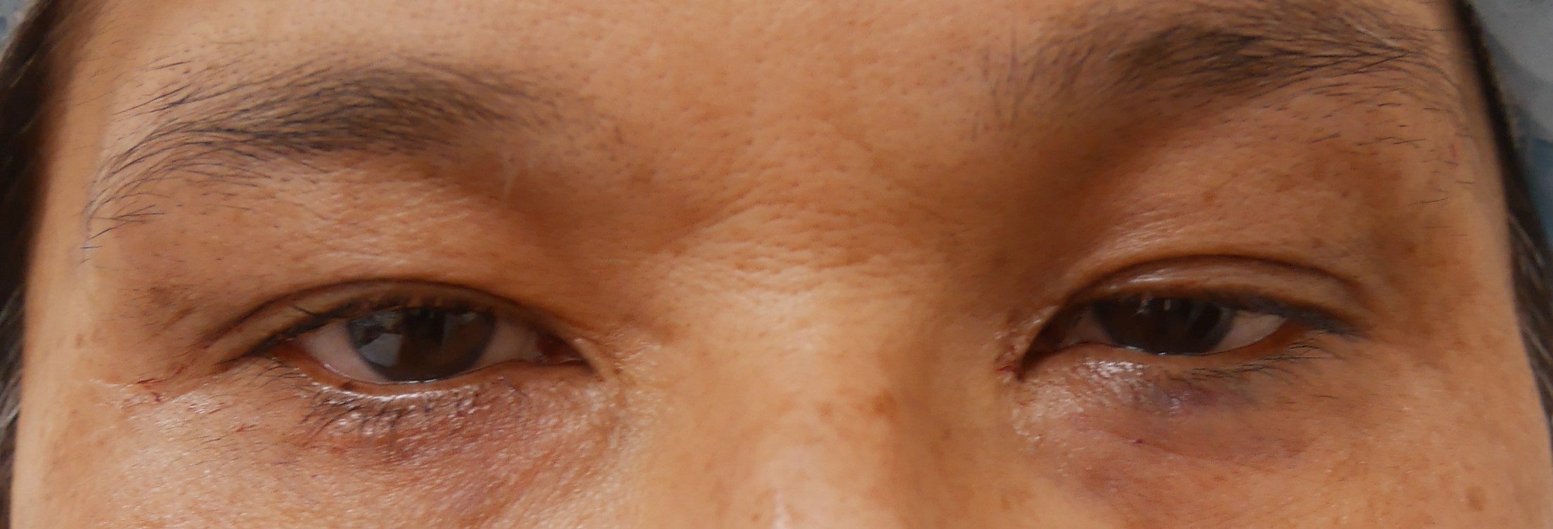 老け顔 疲れた印象 暗いイメージに見られる上まぶたのくぼみの解消法 Dr 松下ブログ 五本木クリニック