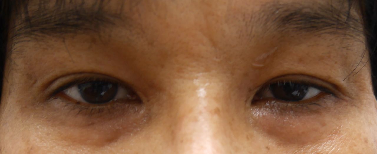 老け顔 疲れた印象 暗いイメージに見られる上まぶたのくぼみの解消法 Dr 松下ブログ 五本木クリニック