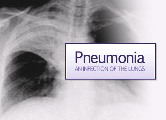 pneumonia-header-view3_jpg__550×410_