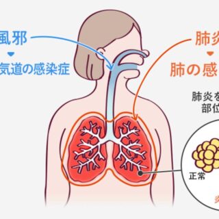 ただの風邪と肺炎の違い