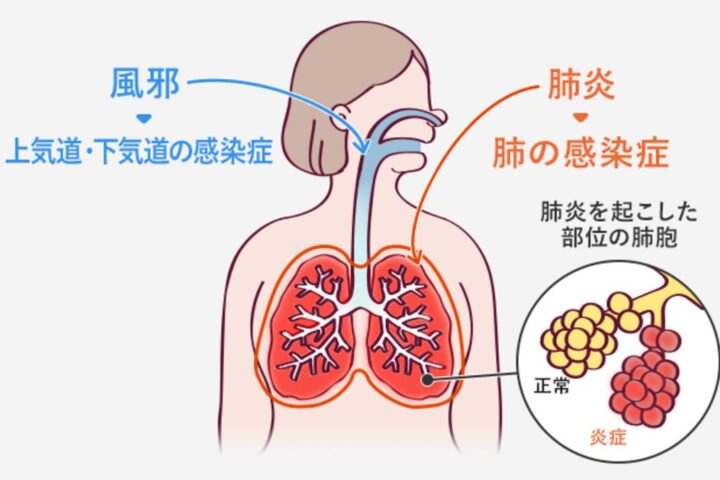 「風邪と肺炎」の違いは自分で見分けられるか？