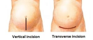 small_C-section_incisions