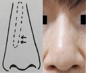 斜めにずれてしまった鼻プロテーゼ