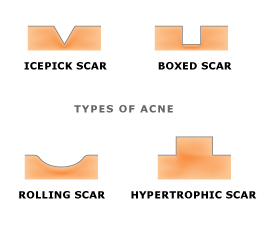 acne_scar