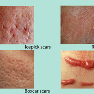 how-to-get-rid-of-scars-and-cuts-left-by-acne