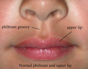 lip___philtrum